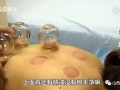 拔罐视频在线观看,跟随视频学习拔罐技巧与体验