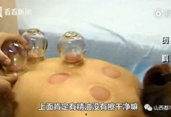 拔罐视频在线观看,跟随视频学习拔罐技巧与体验